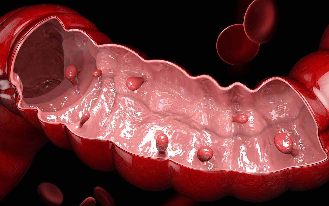 Полипы в толстом кишечнике - что делать?