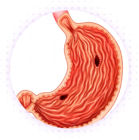 Язвенная болезнь желудка (ЯЖБ)